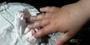 A boy (unnamed) living in the al-Hawl camp in Syria who lost the tip of his finger in an accident. 