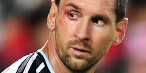Messi with a cut near his eye.