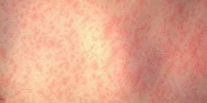 Two measles cases in Brisbane and Logan spark warnings