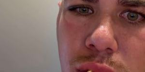 Reece Walsh posted a photo of his fractured cheekbone on Instagram.