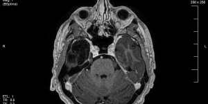 A scan shows black spaces,on the left,where the condition eroded brain tissue in Geoff’s frontal lobe. 