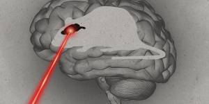 Why aren’t there any good medical treatments for a stroke?