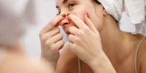 While squeezing blackheads can be satisfying,professional extraction is the safest option.