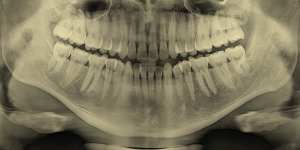 The roots of teeth extend into the upper and lower jawbones,as in this X-ray of adult teeth.