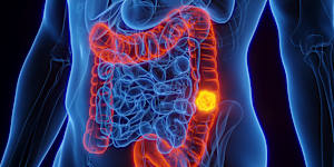Australia has the highest rates of colon cancer in people under 50 in the world.