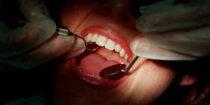 COVID grind causes ‘new pandemic of broken teeth’,dentists warn