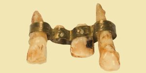 A copy of an Etruscan dental bridge,from 700-500BC,with three natural human teeth held in place by a riveted gold band. 