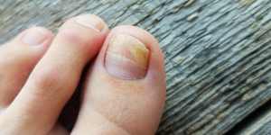 The dodgy nail salon practices fuelling a surge in fungal infections