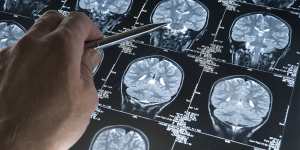 Experimental Alzheimer’s drug slows cognitive decline in trial,firms say