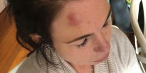 An image of the bruise on Emma Walters’ head.