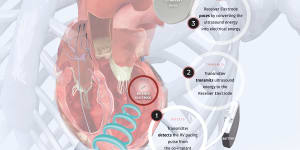 How the EBR Systems’ WISE technology works in the heart. 