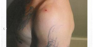 The shoulder injury sustained by Constable Zachary Rolfe when he was stabbed by Kumanjayi Walker.
