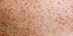 Melbourne hospital exposed to measles infection