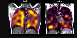 The universities of Oxford,Sheffield,Cardiff and Manchester have been collaborating to try new scanning techniques to pick up less obvious signs of lung damage in long COVID patients (right).