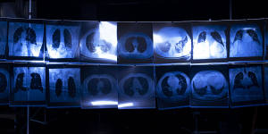 X-rays show the effects of silicosis on victims’ lungs.