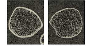 Left,a scan of the trabecular bone of a healthy tibia. Right,a tibia with osteoporosis. 