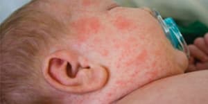 Two babies too young to be vaccinated infected with measles in Sydney