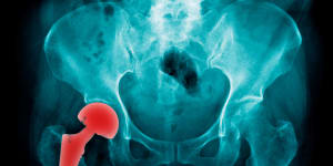 Hip replacement generic 