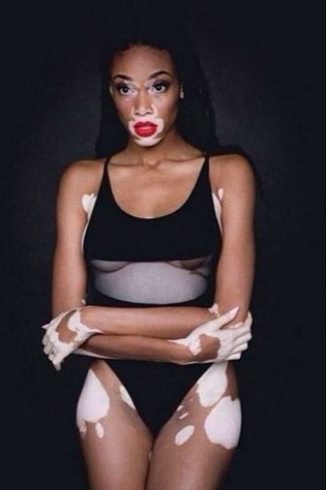 Chantelle Brown-Young, America's Next Top Model Contestant, Has Vitiligo