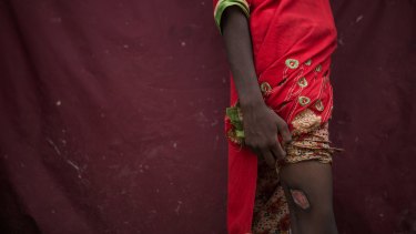 Fatima, 12, shows a scar from a gunshot wound she received a month earlier, when Myanmar Army soldiers surrounded her village and opened fire.