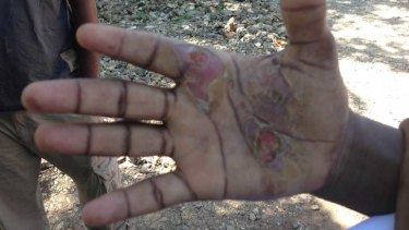 An asylum seeker says the burns on his hands were caused by Australian Navy personnel holding his hands to hot parts of a boat engine.