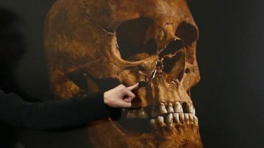 Damage to a skull, believed to be that of Richard III.