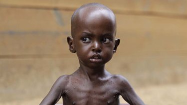 Two-year-old Aden Salaad at a Doctors Without Borders hospital, where he is receiving treatment for malnutrition
