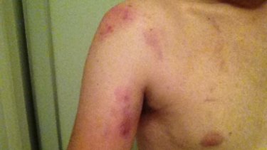 A picture of injuries sustained by Bryn Hutchinson, who has been charged with assaulting police.