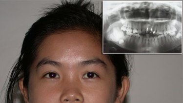 Cambodian girl Sovanna Kak, who is estimated to be 15, will undergo surgery in Brisbane to remove a tumour on her jaw bone (seen in her x-ray inset).