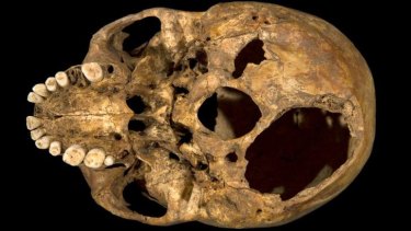 The base of the skull of Richard III showing two potentially fatal injuries. 