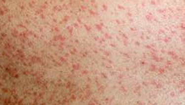 Measles Alert Issued For Melbourne Airport Due To Infected Passenger