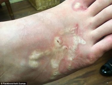 How the hookworms affected Michael Dumas' feet.