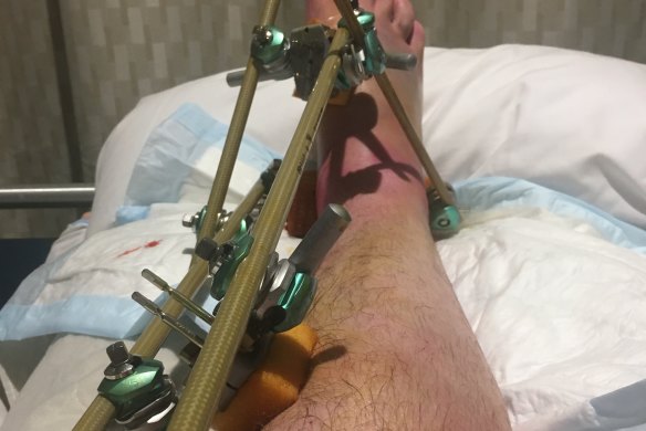 Peter Morley's ankle in a shot taken in hospital.
