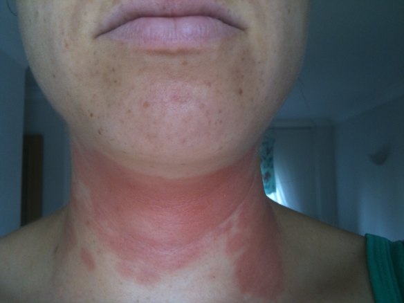 Some of Renee Kacz' symptoms included allergic-style rashes. 