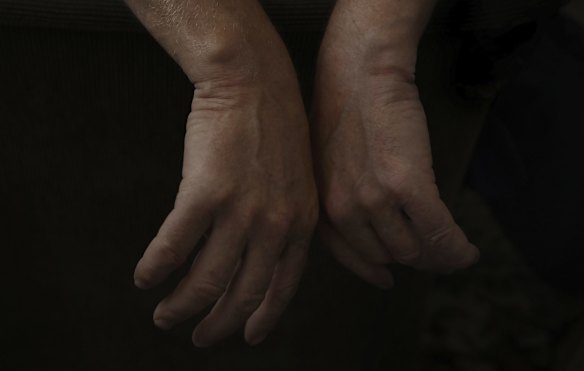 Valentin Barannyk reveals permanent scarring on his wrists from having his hands bound when detained and interrogated by Russian soldiers. He was shot through the right buttock and sustained other injuries including three ribs broken, an injured forehead and a broken nose. Soldiers shot over his ear while he was being interrogated in a mock execution.