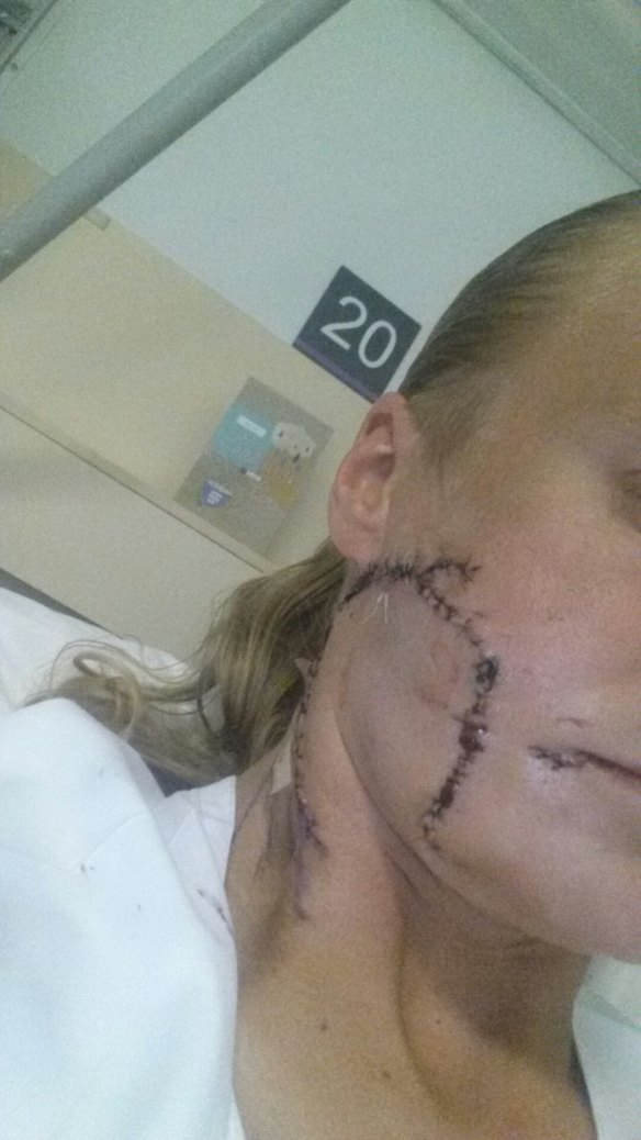 Frankston woman Emma McKnight needed 150 stitches after having her cheek ripped off by a pitbull.