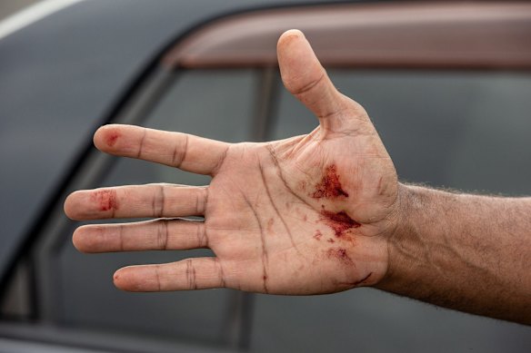 An unidentified man holds out his blood covered hand.