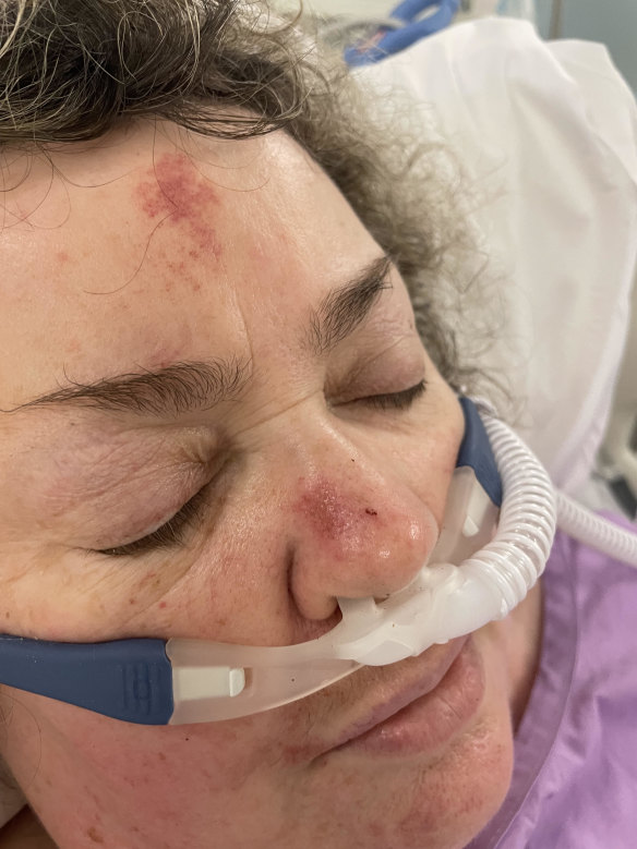 Grafton in hospital after the accident, with facial injuries from her car’s airbags.