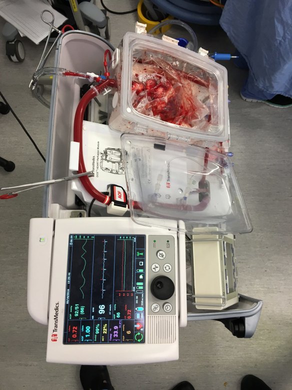 A donor heart re-animated and beating in the ex vivo perfusion rig, after circulatory death. Increasing the pool of potential DCD patients could mean more hearts available for transplant. 