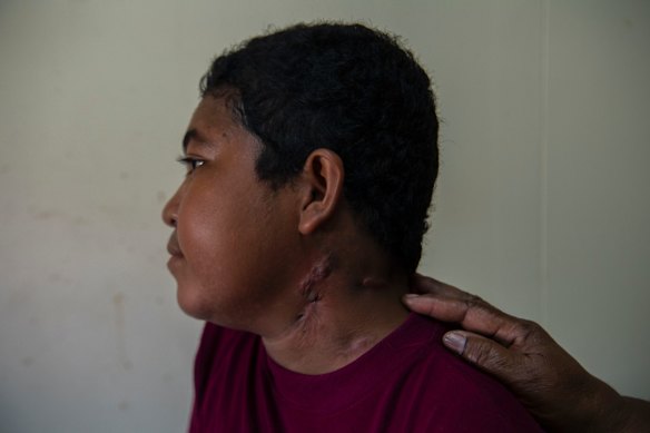 Pictured here in the Port Moresby General Hospital, 13-year-old Karua has multi-drug resistant Tuberculosis.