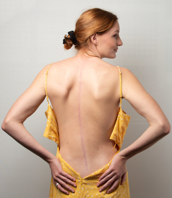 Part of me: Jessica Ashwood shows off the scar from her back surgery. 