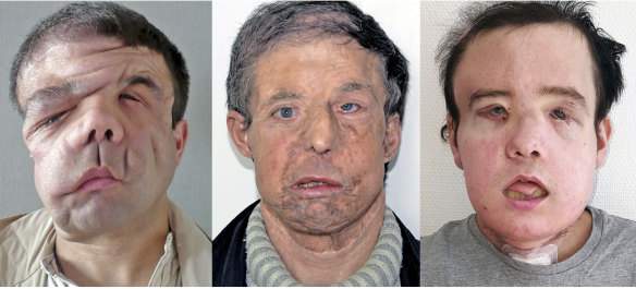 Jerome Hamon before and after two face transplants.
