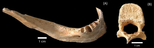 A jawbone that belonged to a Hiroshima atomic bombing victim had absorbed 9.46 grays of radiation. Just half of that is enough to kill a person.  