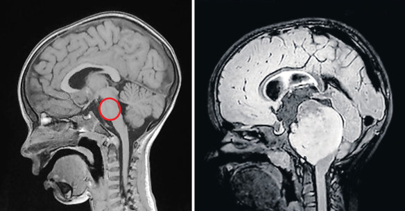 The pons circled on a healthy child’s brain scan (left), shown alongside the brain of a child with diffuse intrinsic pontine glioma (DIPG).