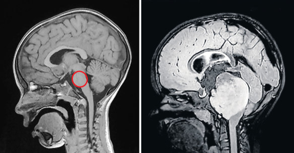 Dipg Diffuse Intrinsic Pontine Glioma An Inoperable And Incurable