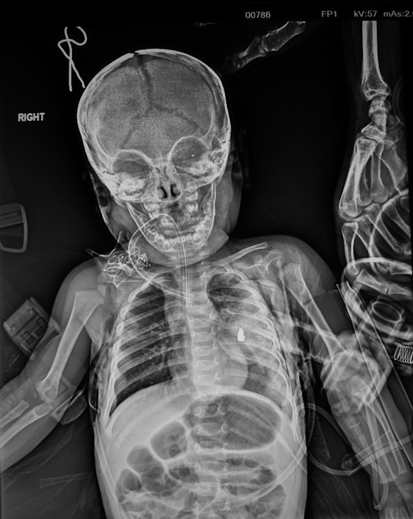 The X-ray of 11-month-old Qasid Radhwan showing the piece of shrapnel in his chest. It caused a part of his lung to collapse.