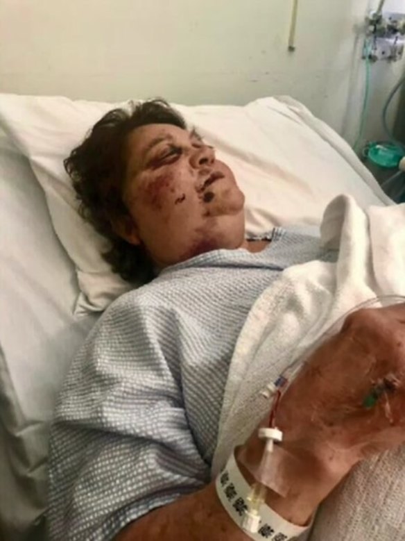 Katsavos in hospital after the attack, in a photo supplied by her family.