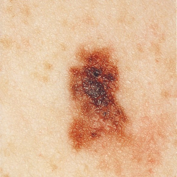 A typical, thin, invasive melanoma.