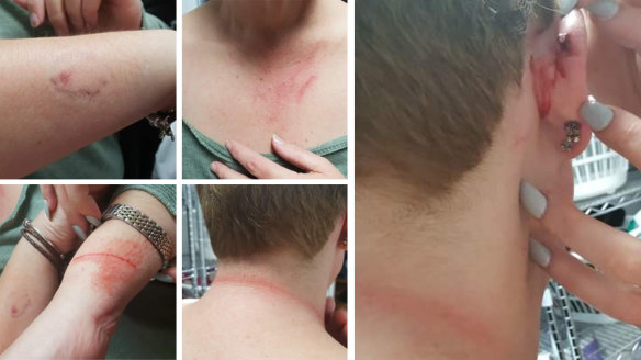 Photos supplied by the union showing injuries sustained at work in the adult mental health unit last week. 