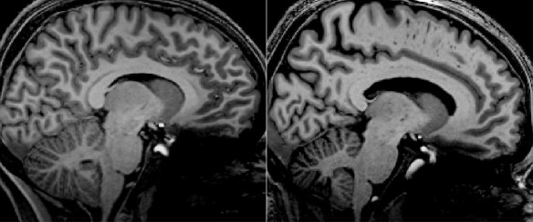 Detailed scans of a long-COVID patient (left) and an ME/CFS patient (right) show similar structures in the brain stem.